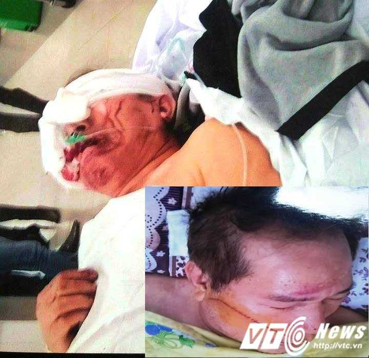 Ông Dương Quang Quýt bị đối tượng Vũ dùng mã tấu chém trọng thương, tổng thương tật là 51 %.