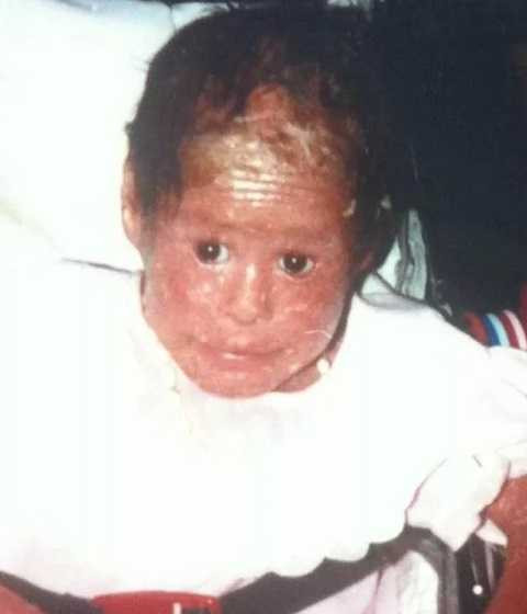 Từ nhỏ, Nelly đã phải chống chọi lại căn bệnh khiến da của cô nứt toác