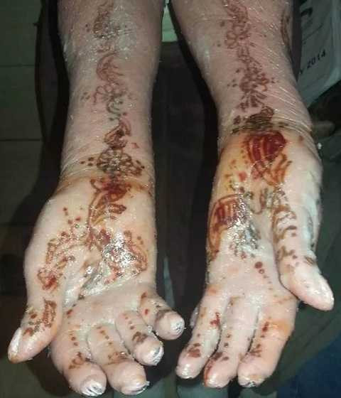 Căn bệnh này là một đột biến gen khiến tế bào da phát triển nhanh gấp 10 lần bình thường