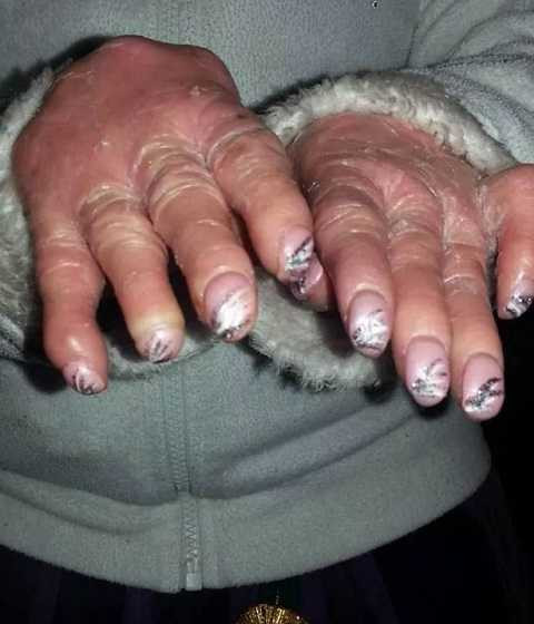 Nelly phải làm sạch da mỗi ngày để tránh viêm nhiễm