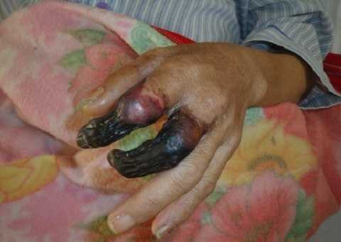 Vi khuẩn uốn ván xâm nhập vào các vết thương, vết xây xước phát triển thành ổ nhiễm trùng Vi khuẩn uốn ván xâm nhập vào các vết thương, vết xây xước phát triển thành ổ nhiễm trùng