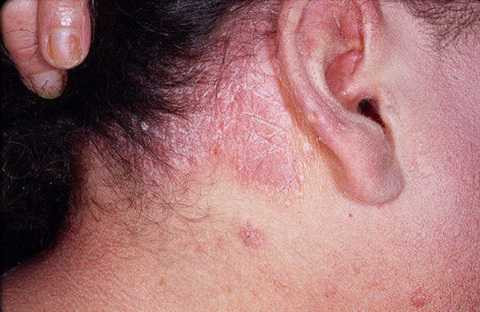 Xuất hiện các đốm màu đỏ cảnh báo bệnh vẩy nến