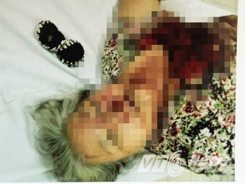 Cụ bà bị côn đồ đánh thương tích