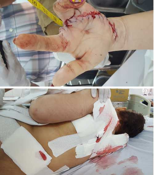 Ngón tay chị T. bị chồng chém lìa và Những vết chém trên lưng chị T.