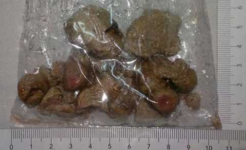 Nếu đã có sỏi thận thì cần đặc biệt tuân thủ chế độ ăn do bác sĩ đề ra Nếu đã có sỏi thận thì cần đặc biệt tuân thủ chế độ ăn do bác sĩ đề ra