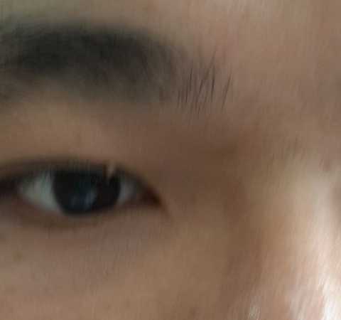 Hình ảnh sùi mào gà mọc ở mắt (Ảnh BS Lợi cung cấp)