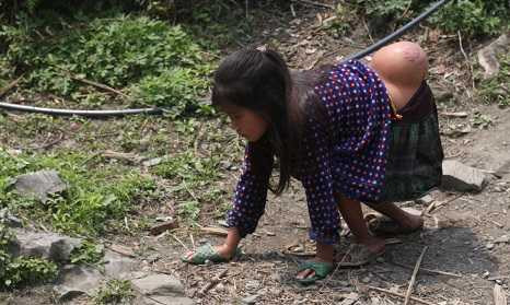 Từ khi sinh ra, cháu Lúa đã phải cõng trên mình khối u khổng lồ.