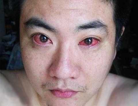 Sử dụng điện thoại ban đêm gây khô kết mạc trong thời gian dài Sử dụng điện thoại ban đêm gây khô kết mạc trong thời gian dài