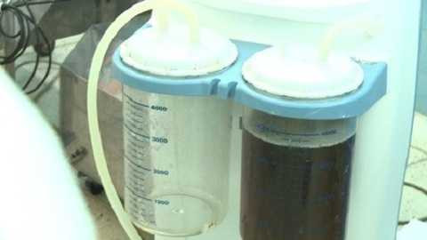 12,5l dịch được hút ra từ khối bướu của bệnh nhân 12,5l dịch được hút ra từ khối bướu của bệnh nhân