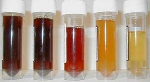 Nhìn màu sắc nước tiểu có thể phần nào chẩn đoán bệnh trong cơ thể Nhìn màu sắc nước tiểu có thể phần nào chẩn đoán bệnh trong cơ thể