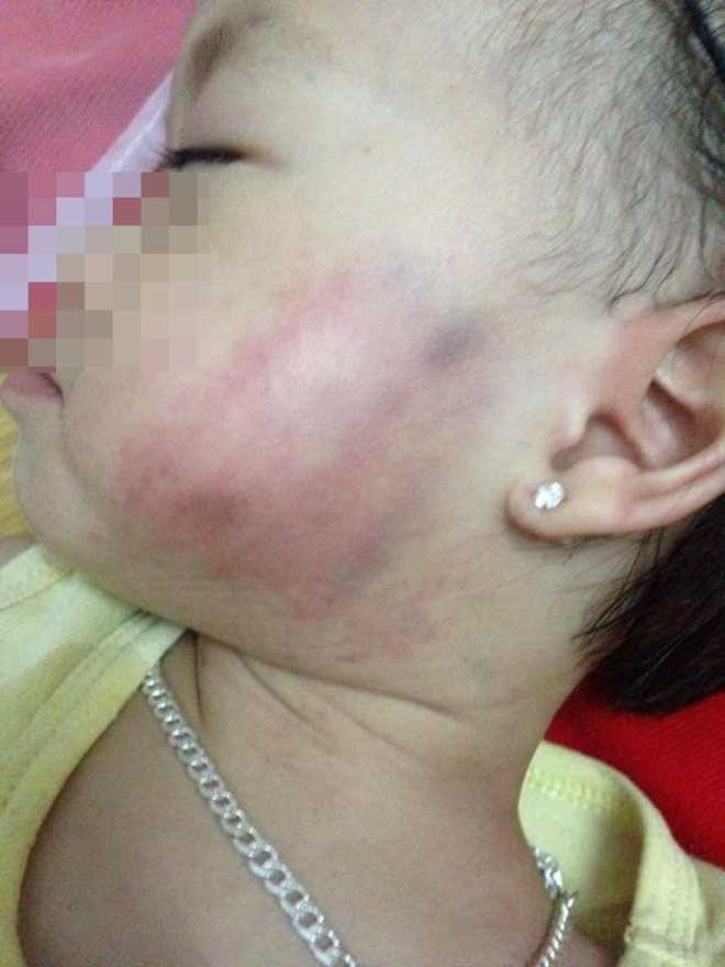 Em bé với nhiều vết bầm tím trên gương mặt. Ảnh: Facebook Họ Vũ Tên Dung.