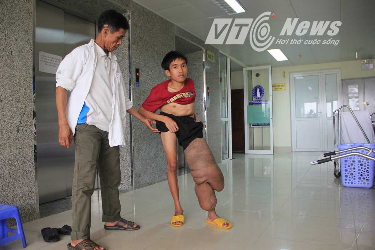 Chân trái Thưởng to như chân voi khiến em đi lại rất khó khăn. Ảnh Đức Thuận