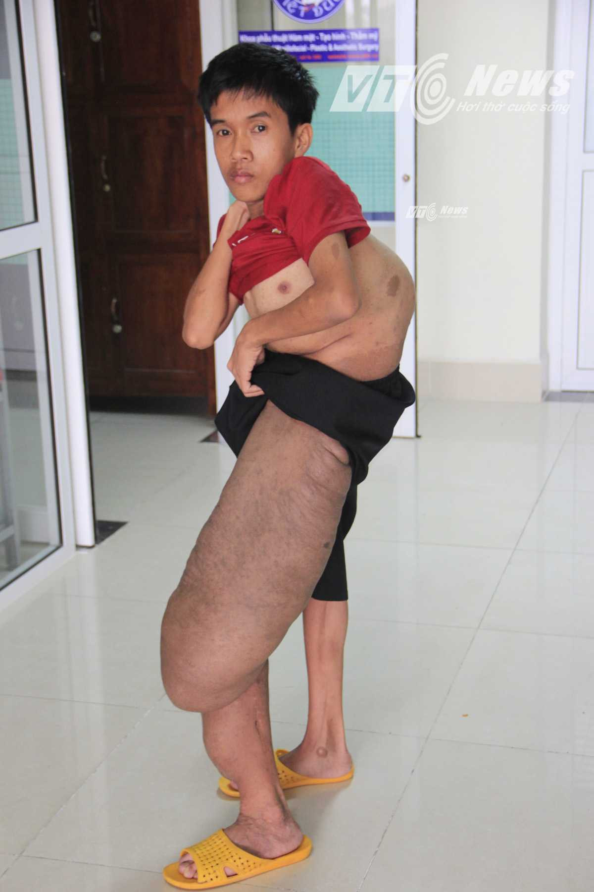 Sau ca phãu thuật hồi 10 tuổi, chân Thưởng bị nhiễm trùng và từ đó nó phình to ra bất thường thành khối u. Thậm chí nó còn lan lên cả lưng. Ảnh Đức Thuận