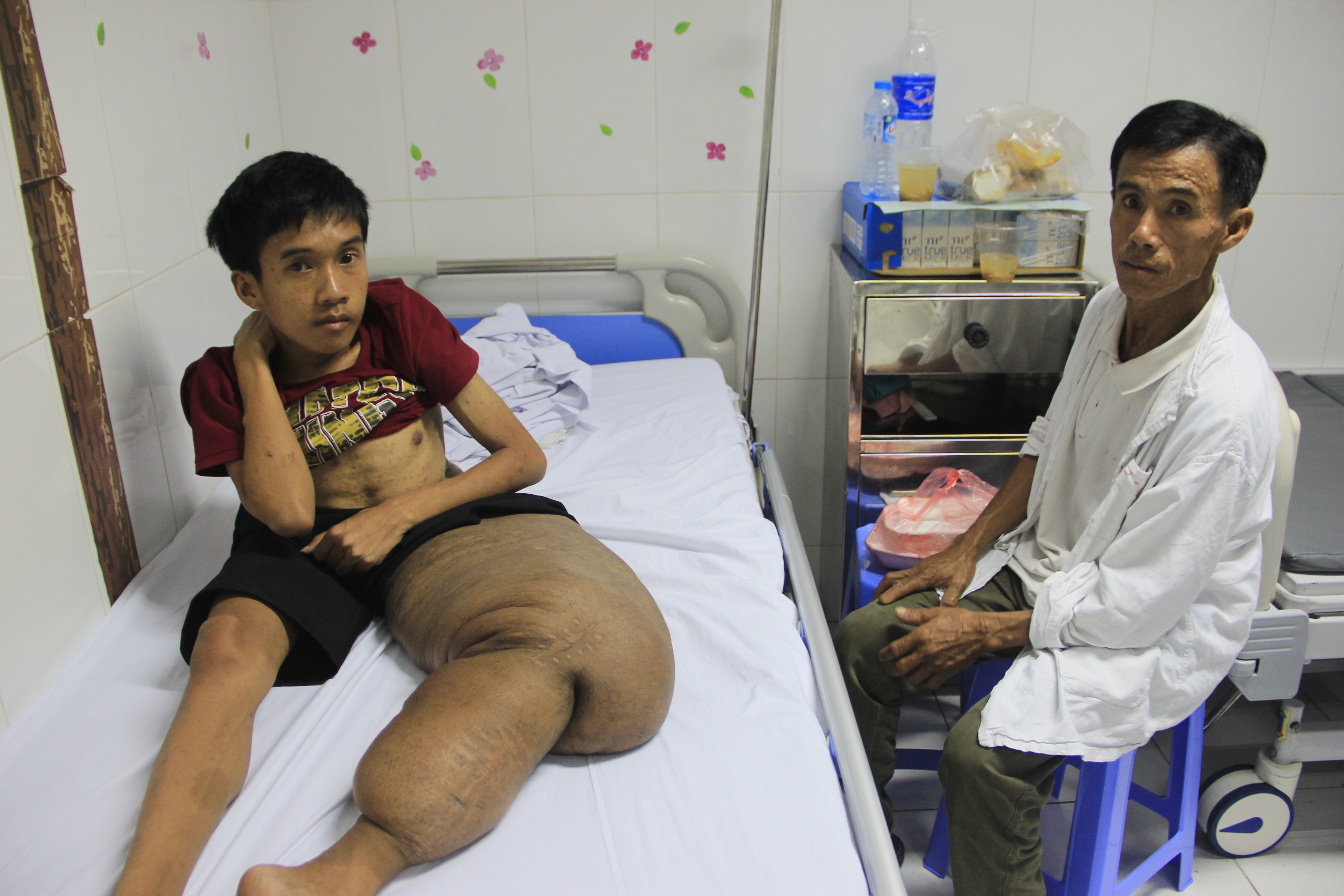 Ông Thành day dứt vì vợ chồng ông nghèo khó không có tiền chữa bệnh cho con nên Thưởng mới khổ như thế này. 