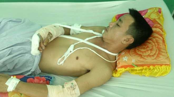 Khủy tay trái và bàn tay phải bị chém tạo vết thương hở, đứt gân