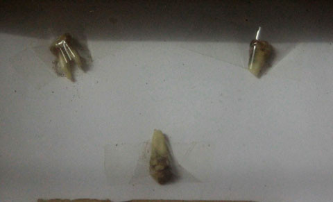 Những chiếc răng bị đục