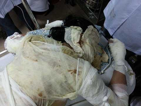 Một công nhân nữ nguy kịch trong số 5 người nặng nhất