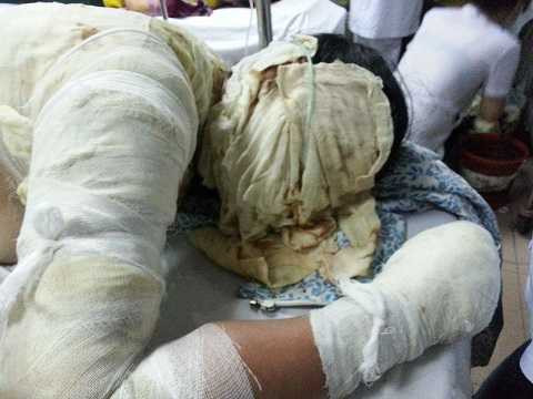 Một số bị bỏng nặng, nguy kịch