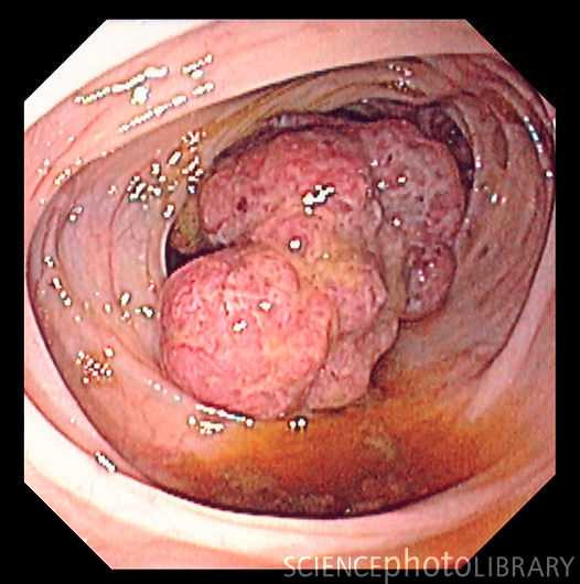 Phát hiện nguy cơ ung thư đại trực tràng