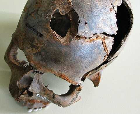 Nhiều bộ xương bị gãy, hộp sọ cũng bị vỡ. Ảnh Dailymail