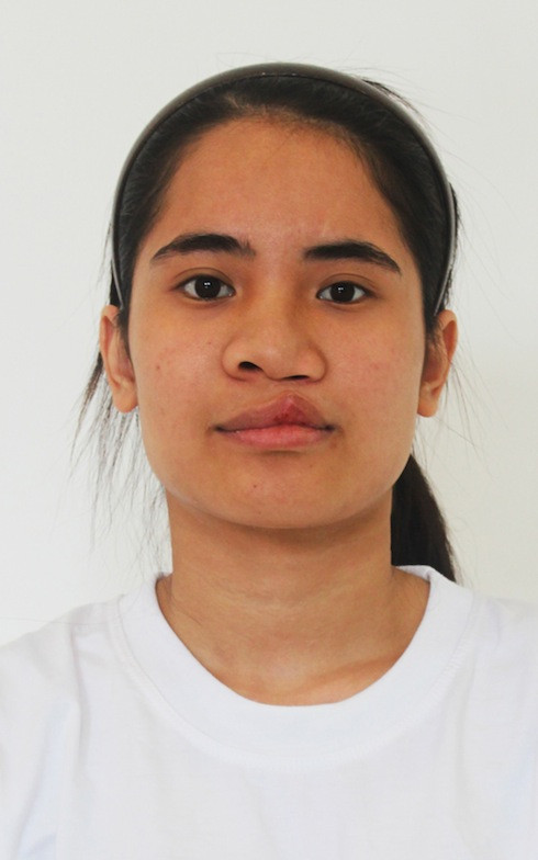 Hoàng Thị Thương – Dị tật bẩm sinh hở hàm ếch