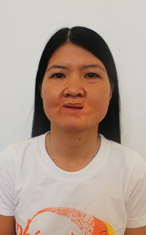 Ca sỹ hát nhạc trịnh Thuỷ Tiên – Với căn bệnh bẩm sinh y khoa gọi là là “Xỉ tổ mả” (một chứng bệnh hiếm gặp) từ khi còn nhỏ và do nhà nghèo nên những vết lở loét xung quanh miệng cô diễn biến rất nặng, chuyển sang giai đoạn hoại tử.