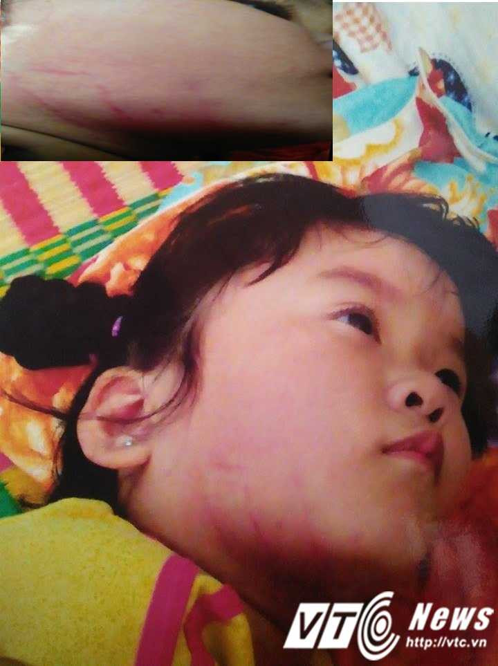Những vết thương như bị dùng thước đánh trên mặt cháu Minh Uyên.