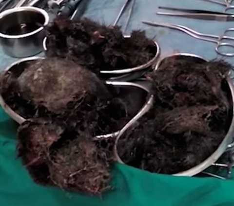 Cô gái có thói quen ăn tóc trong suốt 5 năm. Cô gái có thói quen ăn tóc trong suốt 5 năm.