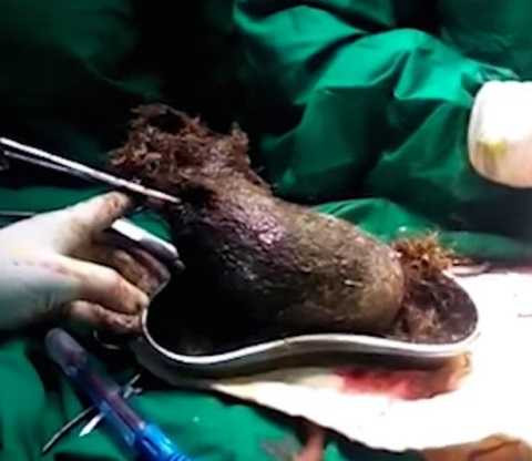 Mất hơn 1 giờ để các bác sĩ lấy hết búi tóc. Mất hơn 1 giờ để các bác sĩ lấy hết búi tóc.