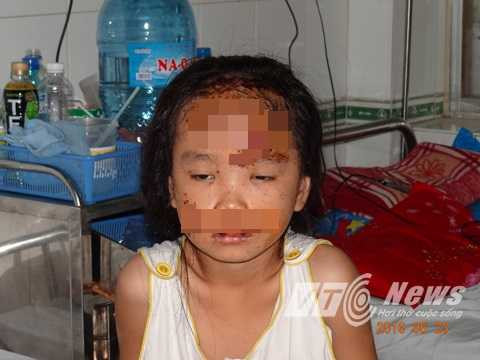  Bé Lê Ngọc Anh (7 tuổi) - con gái chị Huê, bị thương tích vùng đầu, mặt, miệng môi bị sưng nên không thể nói chuyện được. Ảnh: Phan Cường