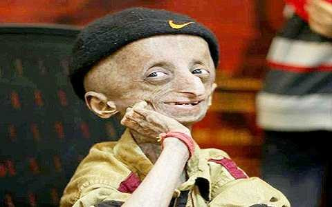 cậu bé Nihal Shrinivas Bitla mắc hội chứng Progeria, một căn bệnh lão hóa hiếm gặp khiến cơ thể cậu già nhanh hơn người bình thường gấp 8 lần cậu bé Nihal Shrinivas Bitla mắc hội chứng Progeria, một căn bệnh lão hóa hiếm gặp khiến cơ thể cậu già nhanh hơn người bình thường gấp 8 lần