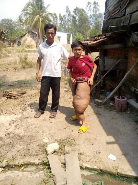 Thưởng vẫn phải chờ đợi để được phẫu thuật cái chân voi của mình.