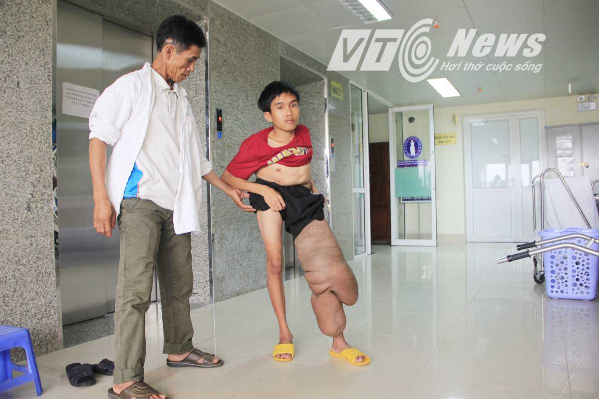 Chân trái Thưởng to như chân voi khiến em đi lại rất khó khăn. Ảnh Đức Thuận 