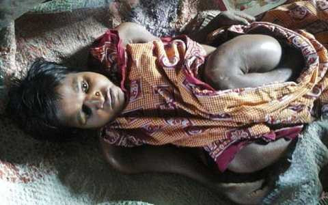 Kumari mắc phải căn bệnh xương hiếm gặp khiến cô không thể đi lại, tay chân cong như cành cây. Ảnh Mirror