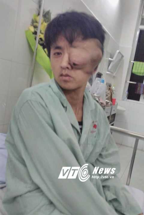 Xót xa người đàn ông mắt lòi ra khỏi tròng vì khối u khổng lồ