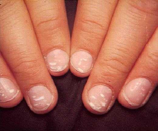 Xuất hiện đốm trắng trên móng tay, có thể bạn đã mắc bệnh gan