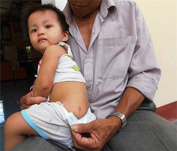 Đứa bé con anh Đỗ Văn Hồng là một trong những trẻ bị côn trùng lạ tấn công với vết sẹo đỏ tấy
