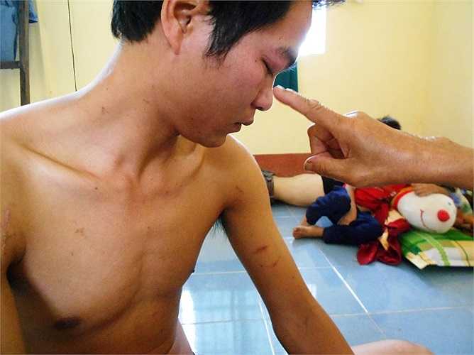 Khắp cơ thể và mắt sưng húp sau khi bị côn trùng đốt