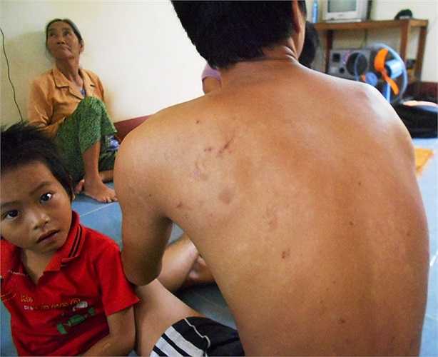 Khắp cơ thể anh Trần Văn Sang con chị Tý đầy rẫy những vết sẹo do côn trùng đốt để lại