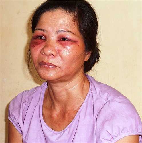 Vùng mắt chị Nguyễn Thị Tý bị sưng húp, đỏ tái, mọng mủ và đau rát do côn trùng lạ cắn