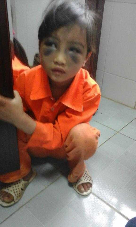 Bé Thủy bị đánh bầm tím mặt 