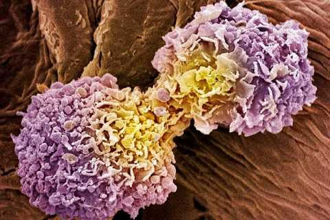 Tế bào ung thư vú