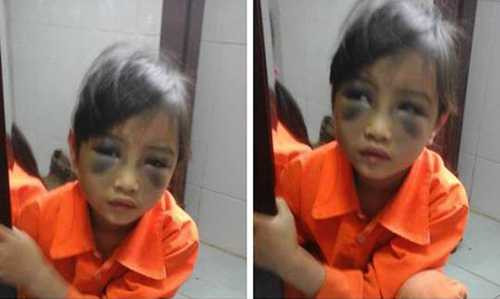 Hình ảnh nữ sinh lớp 1 Phàn Chung Thuỷ bị đánh tím mặt gây bức xúc dư luận. 