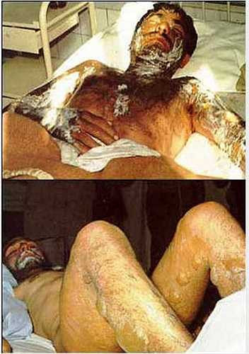 Ở một cuộc chiến khác, khoảng 100.000 binh sĩ Iran là nạn nhân của các cuộc tấn công hóa học bởi Iraq, trong đó có đến 20.000 binh sĩ đã thiệt mạng.