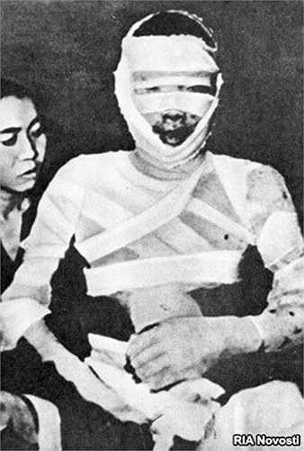 Một người đàn ông Việt Nam bị bỏng toàn thân do các chất hóa học gây ra trong một cuộc chiến của Mỹ tại Việt Nam.