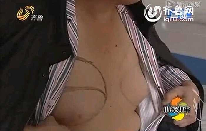 Vì uống thuốc chữa vô sinh trong một thời gian dài nên ông Tiết (45 tuổi), người Trung Quốc, đã bị chứng ngực to bất thường. 