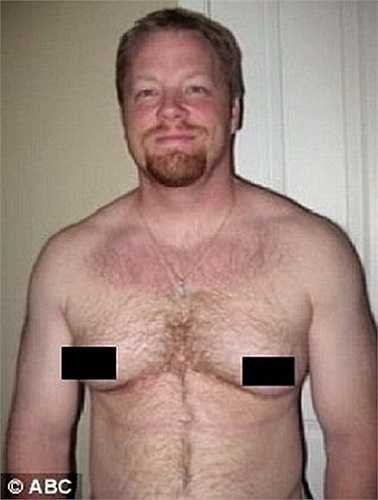 Năm 1994, anh Erik Holler, người Mỹ phát hiện ra mình có một cái bướu nhỏ nằm ở đầu ngực bên trái. Sau đó, ngực anh Erik bỗng phát triển không khác gì ngực phụ nữ. 