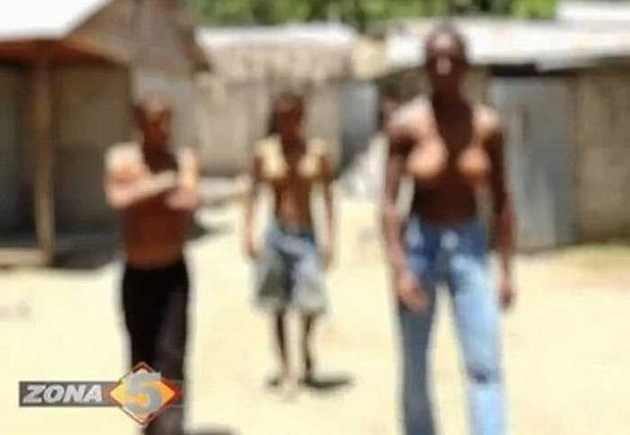 3 anh em nhà Ramírez: Yeuri (17 tuổi), Daniu (12 tuổi) và Gabriel (11 tuổi) ở Cộng hòa Dominican đều sở hữu bộ ngực khủng hơn cả phụ nữ do mắc phải chứng rối loạn gien hiếm gặp. 