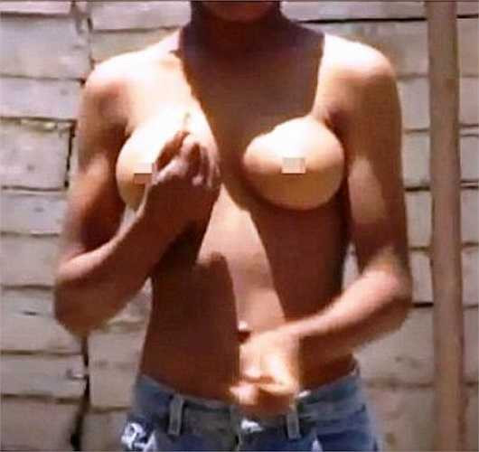 Đây là hiện tượng đàn ông vú to(gynecomastia), nó ảnh hưởng đến sự cân bằng hoóc môn trong cơ thể.