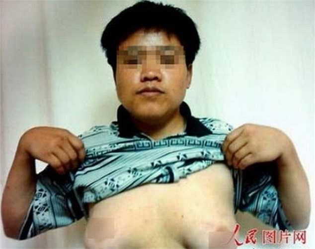 Uông Chí, 18 tuổi, sống tại Trùng Khánh (Trung Quốc)có vòng một nở nang kỳ lạ. Nguyên nhân vì để tẩm bổ sức khỏe cho con trai, bố mẹ cậu liên tục thúc ép con ăn, uống những thực phẩm giàu dinh dưỡng như canh hầm ngân nhĩ. 